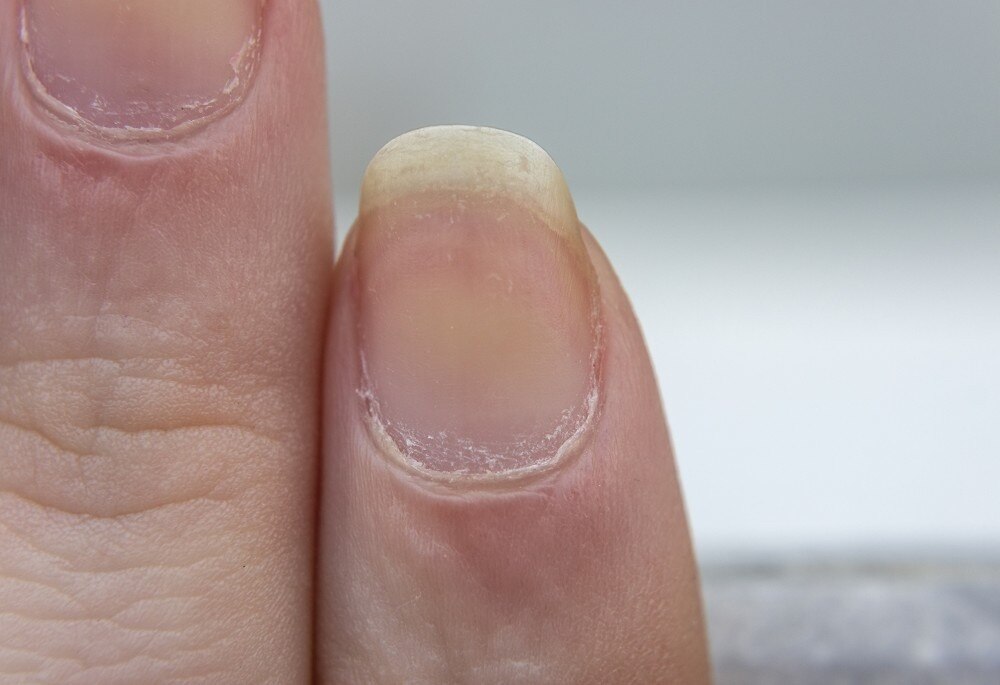 3 Tips for Preventing Toenail Fungus | Podiatry Center of New Jersey